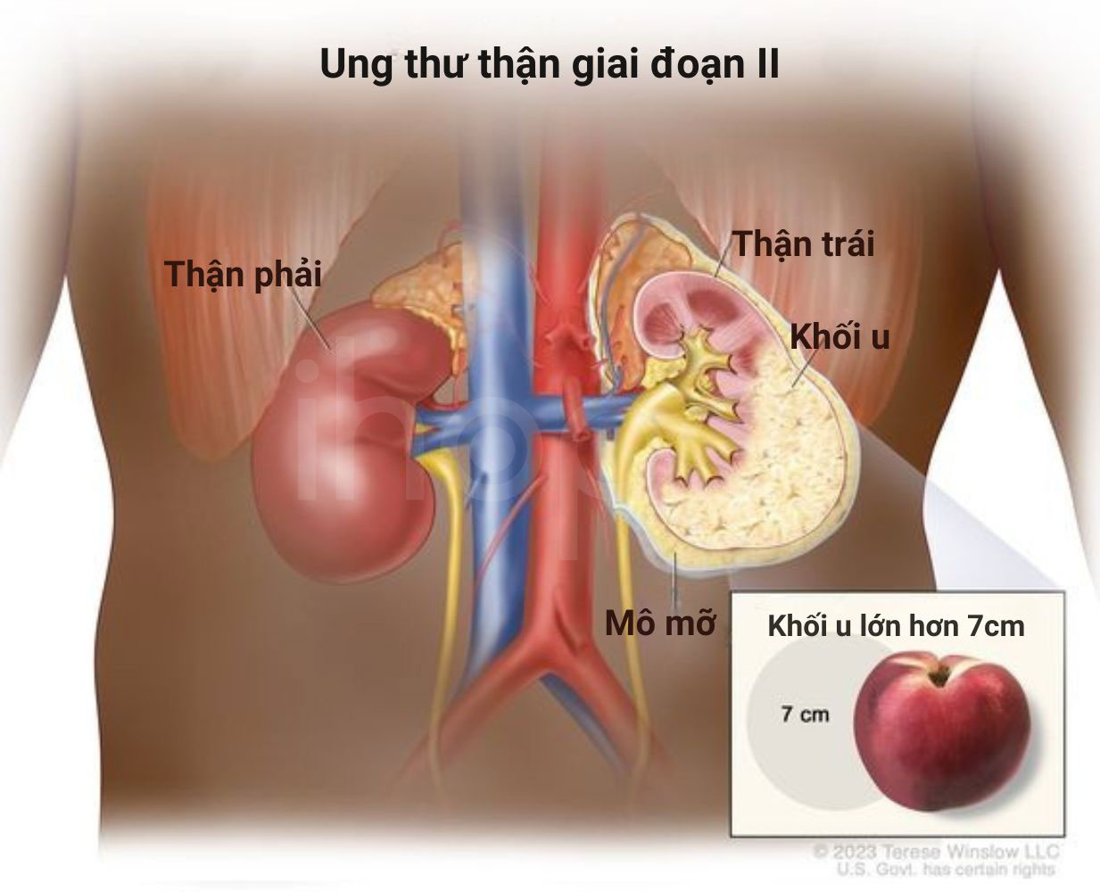 Ung thu than giai doan II