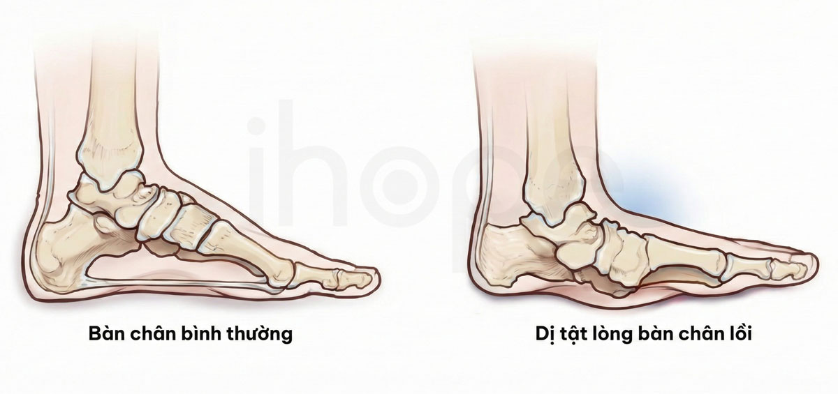 Dị tật lòng bàn chân lồi