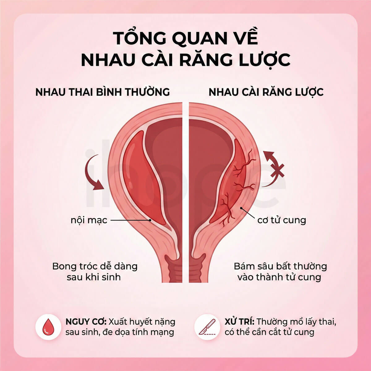 Nhau thai bình thường và nhau cài răng lược