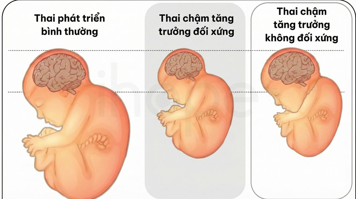 Các dạng thai chậm tăng trưởng