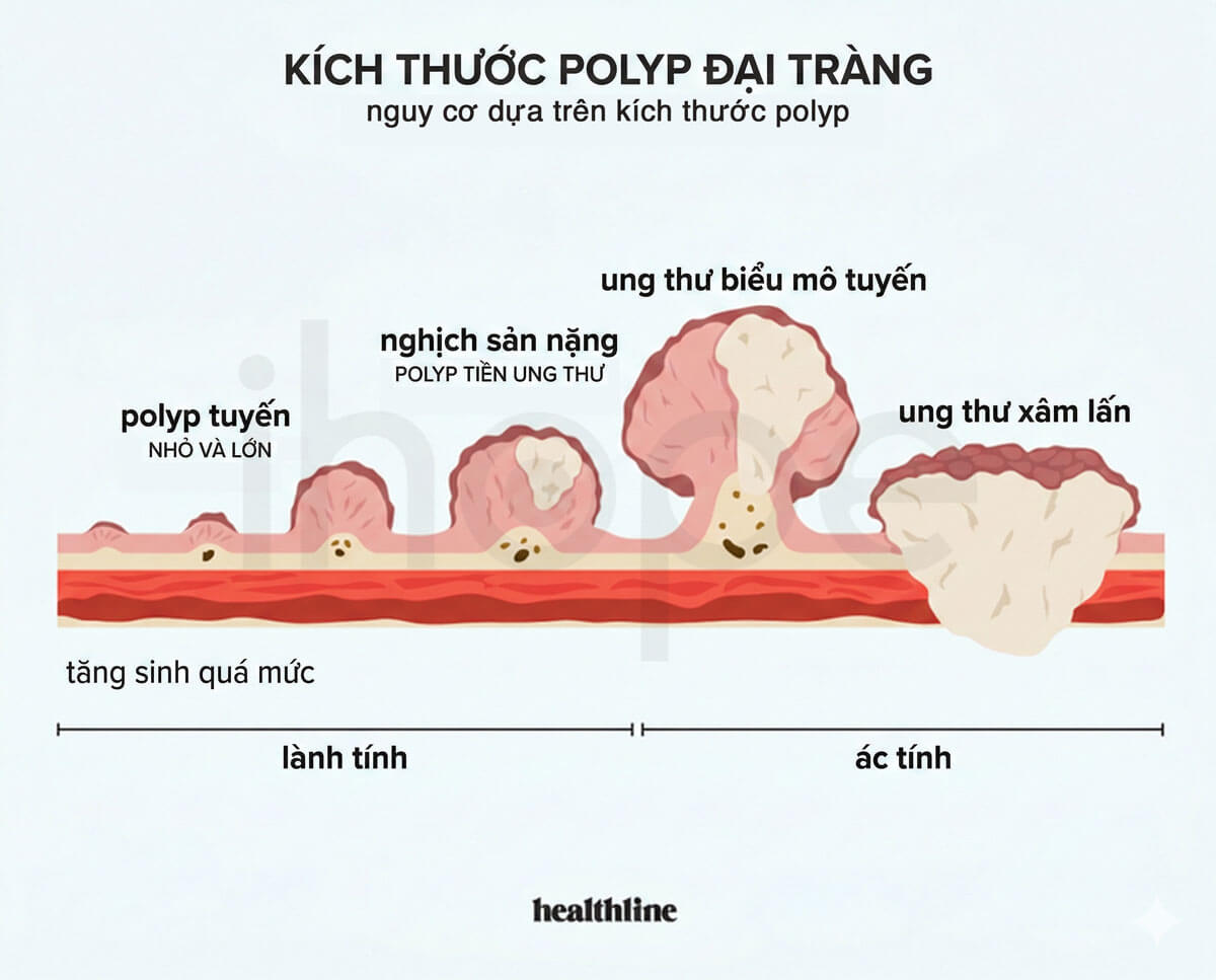 Phân loại kích thước và loại polyp đại trực tràng