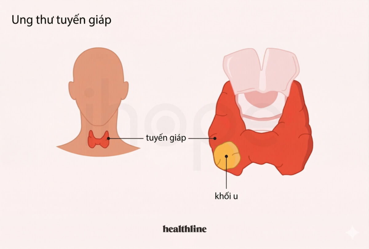 Ung thư tuyến giáp